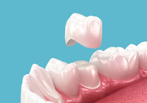 CEREC Same-Day Crowns